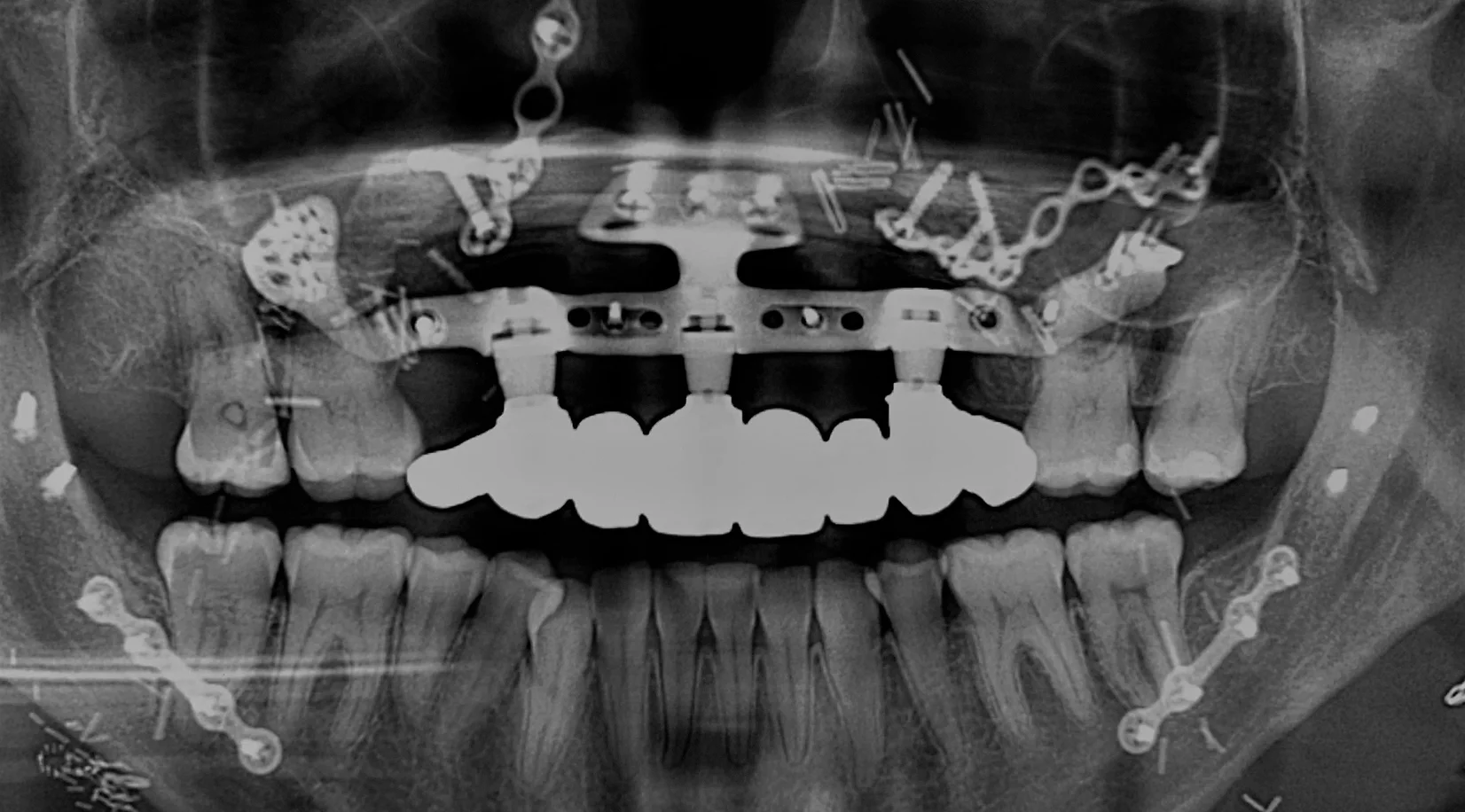 omx_x-ray_craniomaxillofacial_surgery.webp